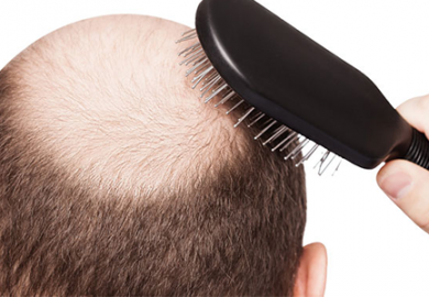 Sunt tehnicile de transplant de păr importante?